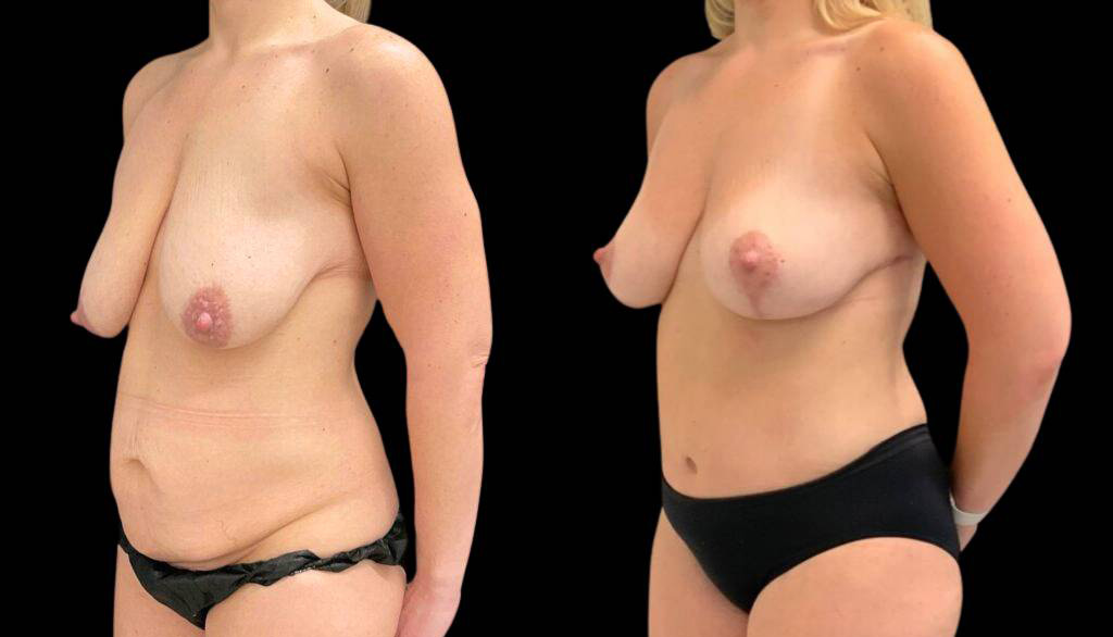 41-year-old-female-breast-lift-before-and-after-three-quarter-view.jpg
