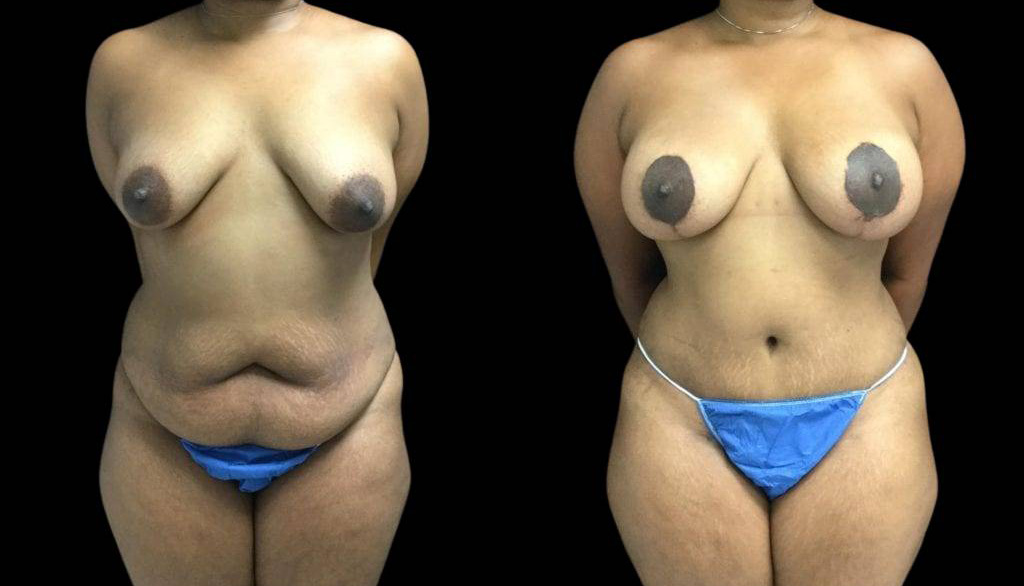 41-year-old-female-mommy-makeover-body-before-and-after-front-view-28522.jpg