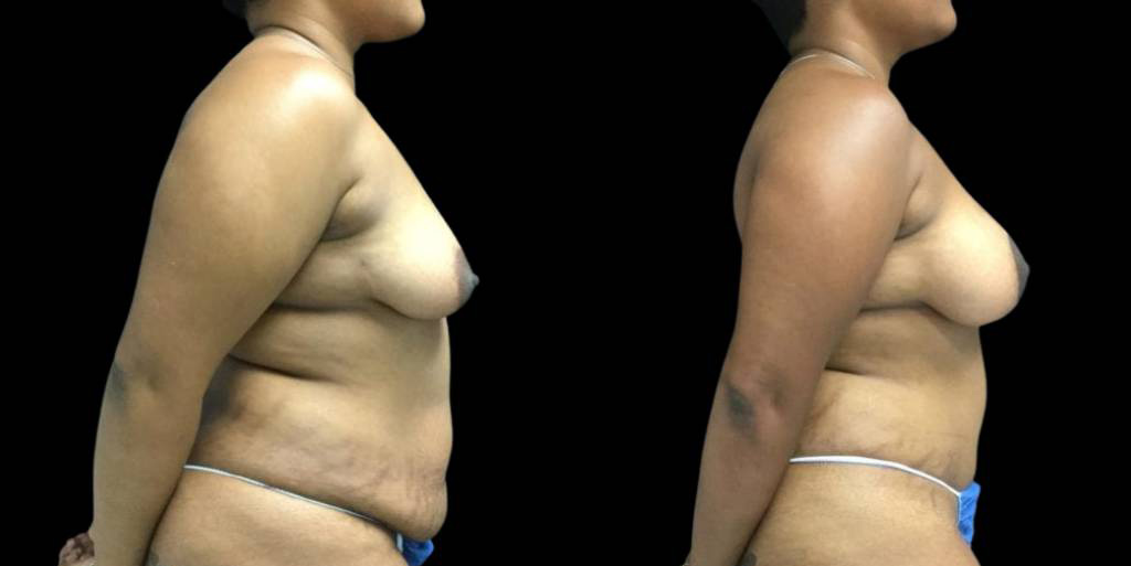 41-year-old-female-mommy-makeover-body-before-and-after-side-view-1.jpg
