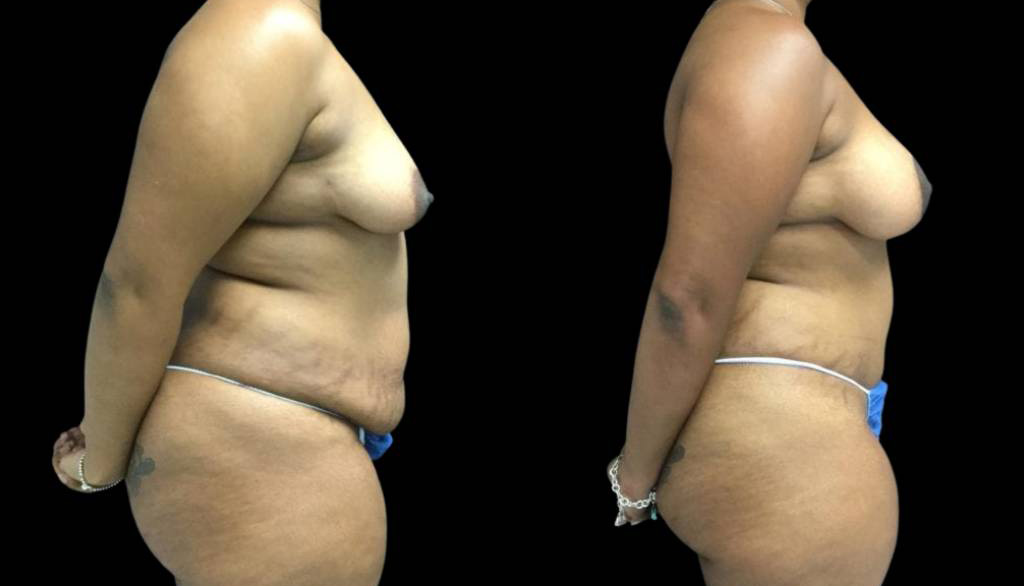 41-year-old-female-mommy-makeover-body-before-and-after-side-view-1.jpg