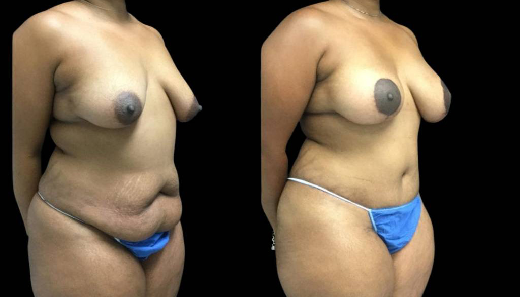 41-year-old-female-mommy-makeover-body-before-and-after-three-quarters-view-1.jpg