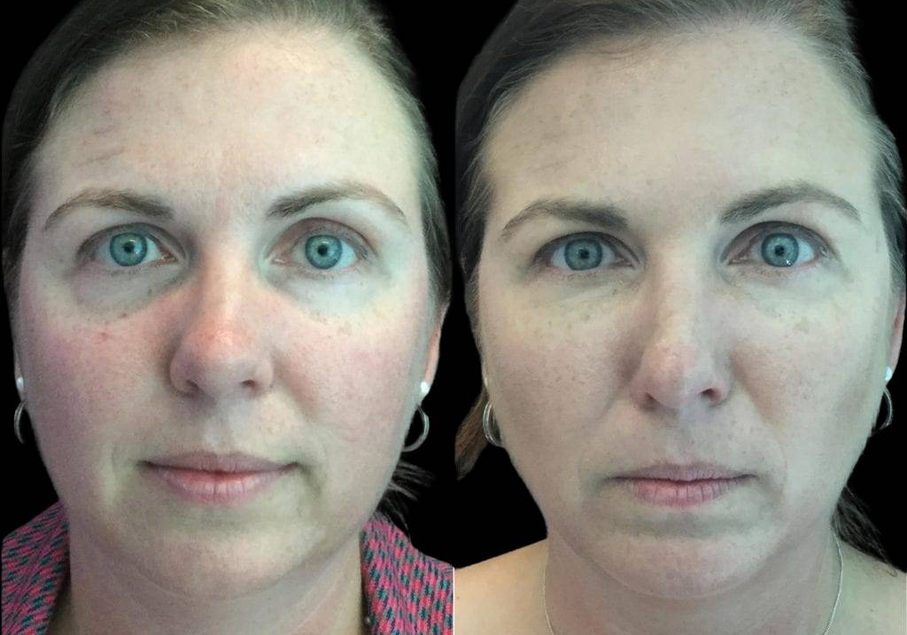 41-year-old-female-restylane-before-and-after-front-view-29563.jpg