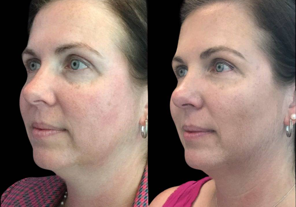 41-year-old-female-restylane-lift-before-and-after-three-quarter-view.jpg