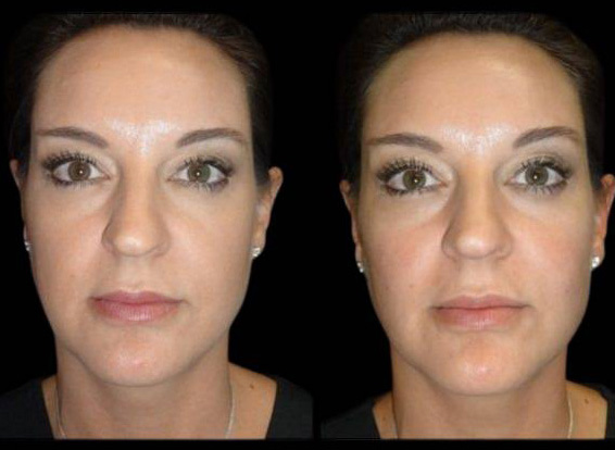41-year-old-female-voluma-before-and-after.jpg
