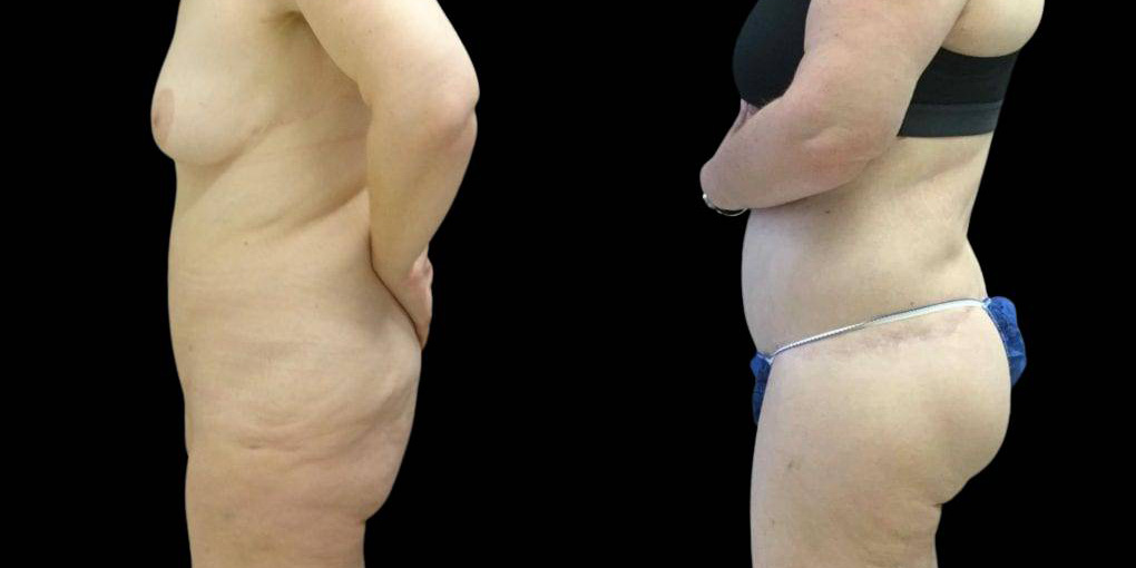This is a female that has had surgery after weight loss showing the before and after's side-by-side