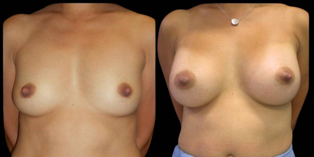 This is a 42-year-old female that has had a breast augmentation and implant showing the before and after's side-by-side