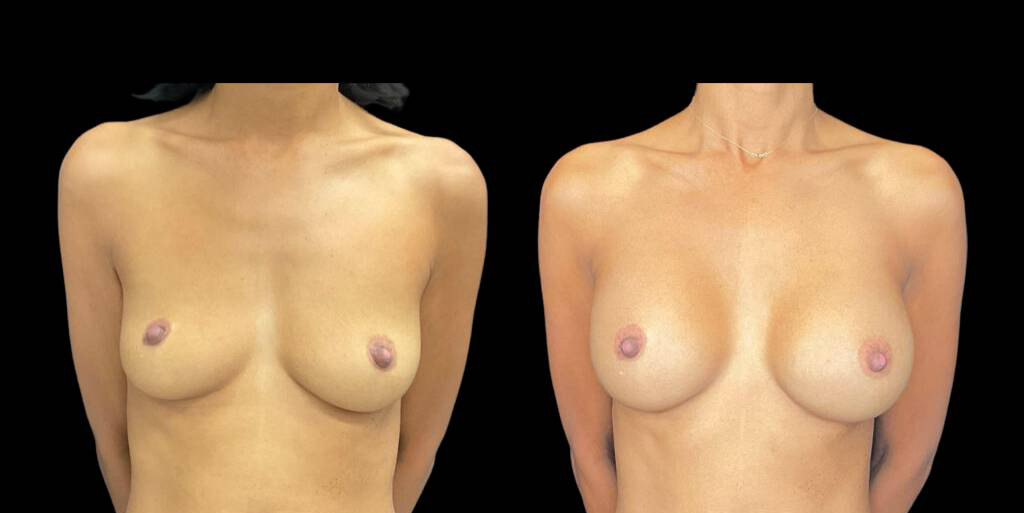This is a 42-year-old female that has had a breast augmentation and implant showing the before and after's side-by-side