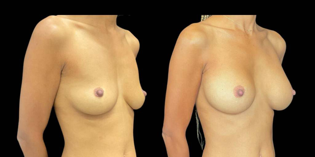 This is a 42-year-old female that has had a breast augmentation and implant showing the before and after's side-by-side