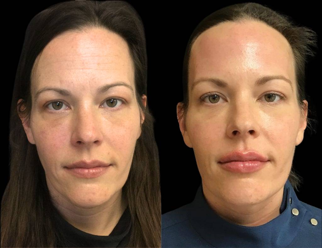 This is a 42-year-old female that has had a lip augmentation showing the before and after's side-by-side
