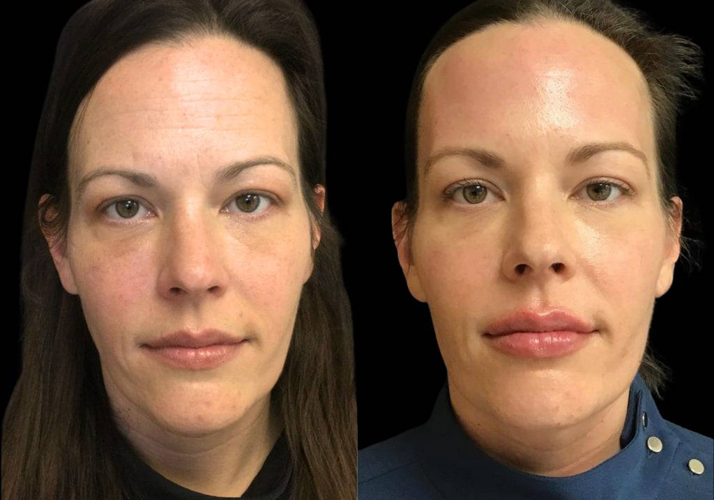 42-year-old-female-lip-augmentation-before-and-after-front-view-11847.jpg