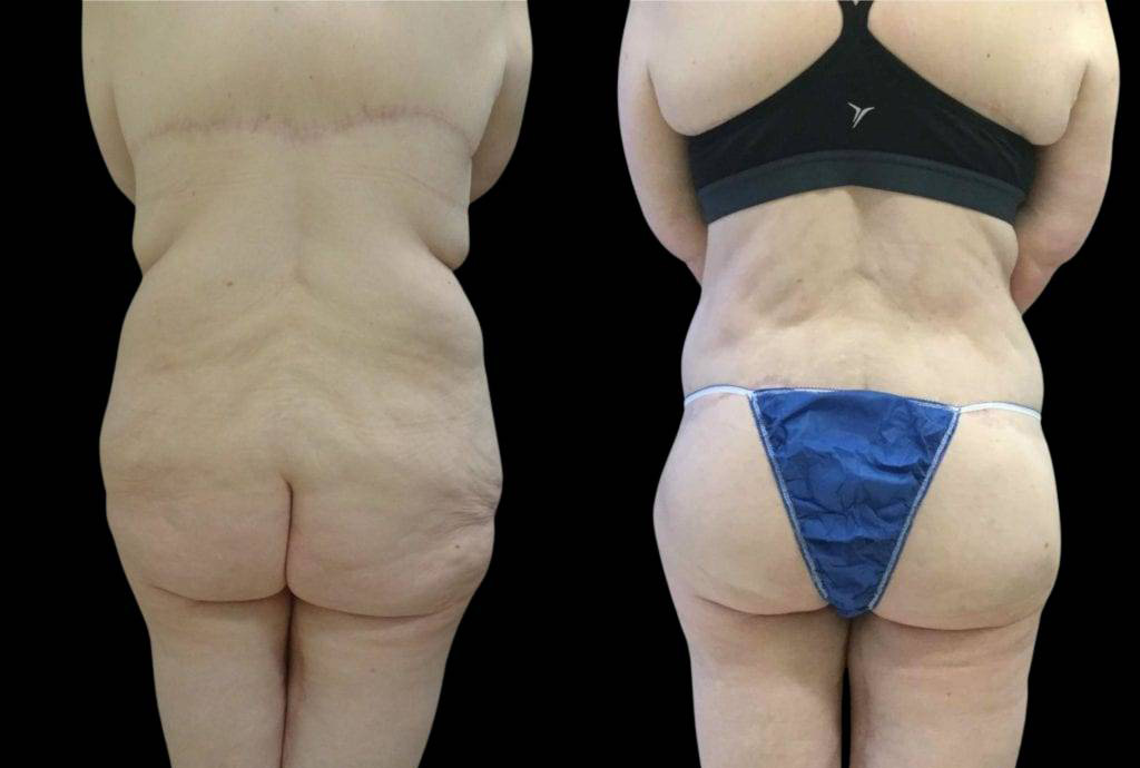 42-year-old-female-lower-body-lift-before-and-after-back-view-1285.jpg
