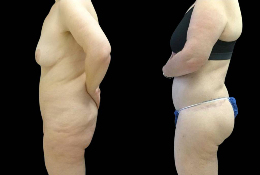 42-year-old-female-lower-body-lift-before-and-after-side-view.jpg