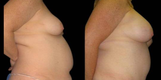 This is a 42-year-old female that has had a mommy makeover showing the before and after's side-by-side