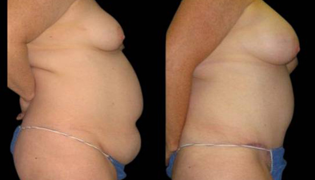 42-year-old-female-mommy-makeover-body-before-and-after-side-view.jpg