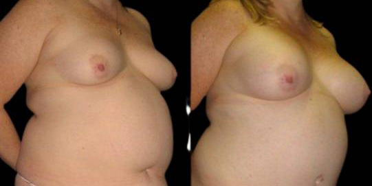 This is a 42-year-old female that has had a mommy makeover showing the before and after's side-by-side