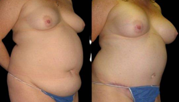 42-year-old-female-mommy-makeover-body-before-and-after-three-quarters-view-10092.jpg