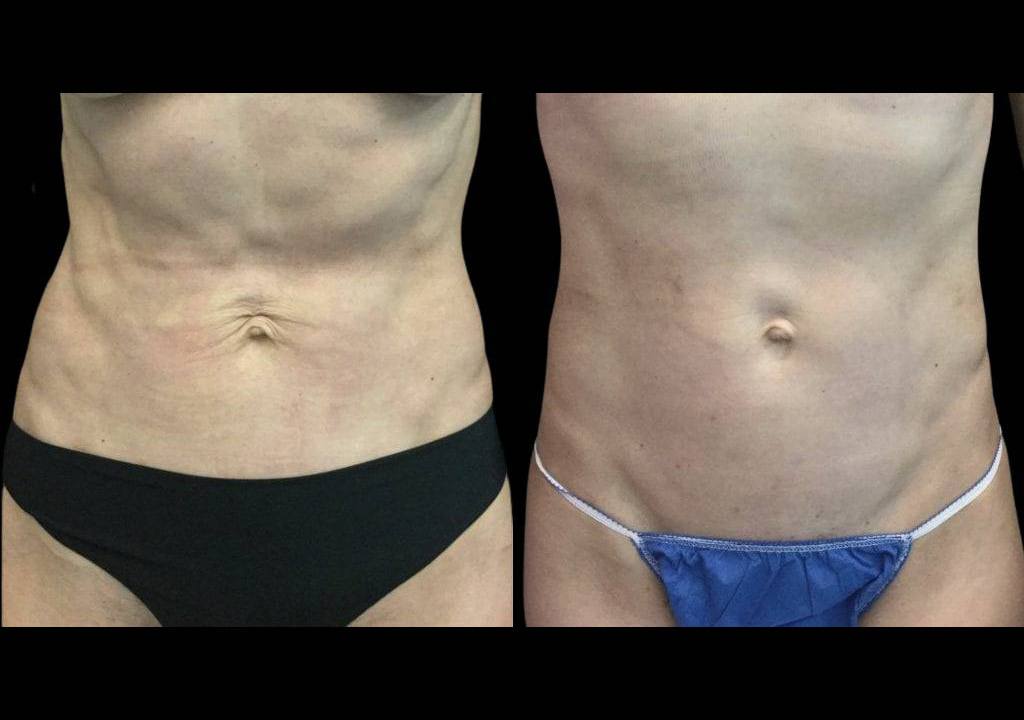 42-year-old-female-non-surgical-tummy-tuck-before-and-after.jpg