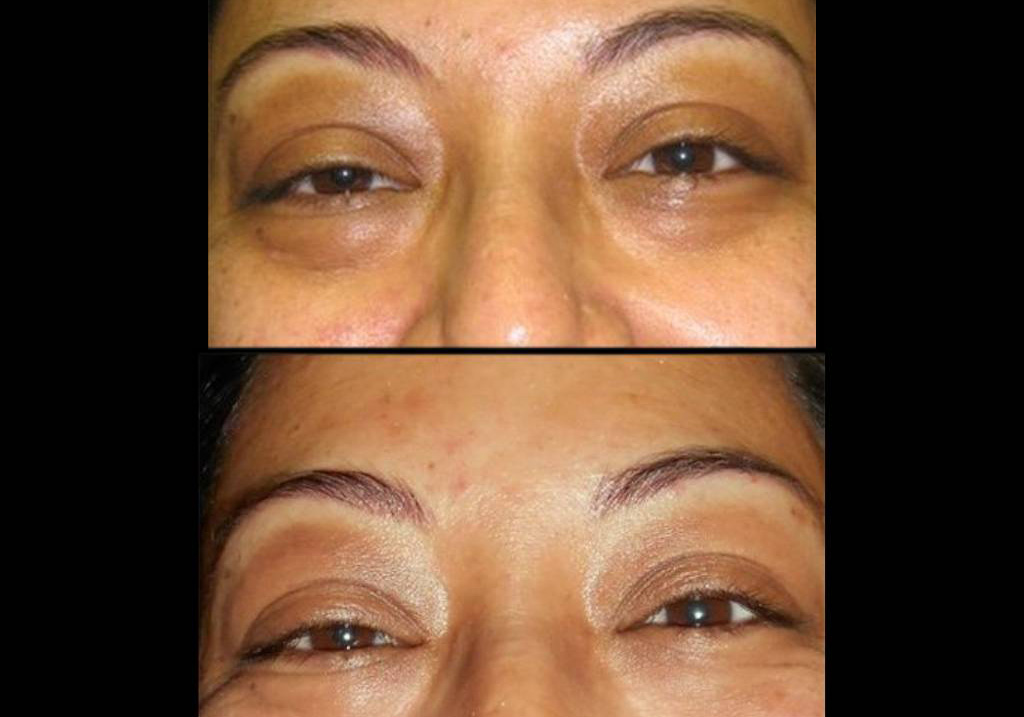 42-year-old-female-restylane-before-and-after-front-view-12404.jpg