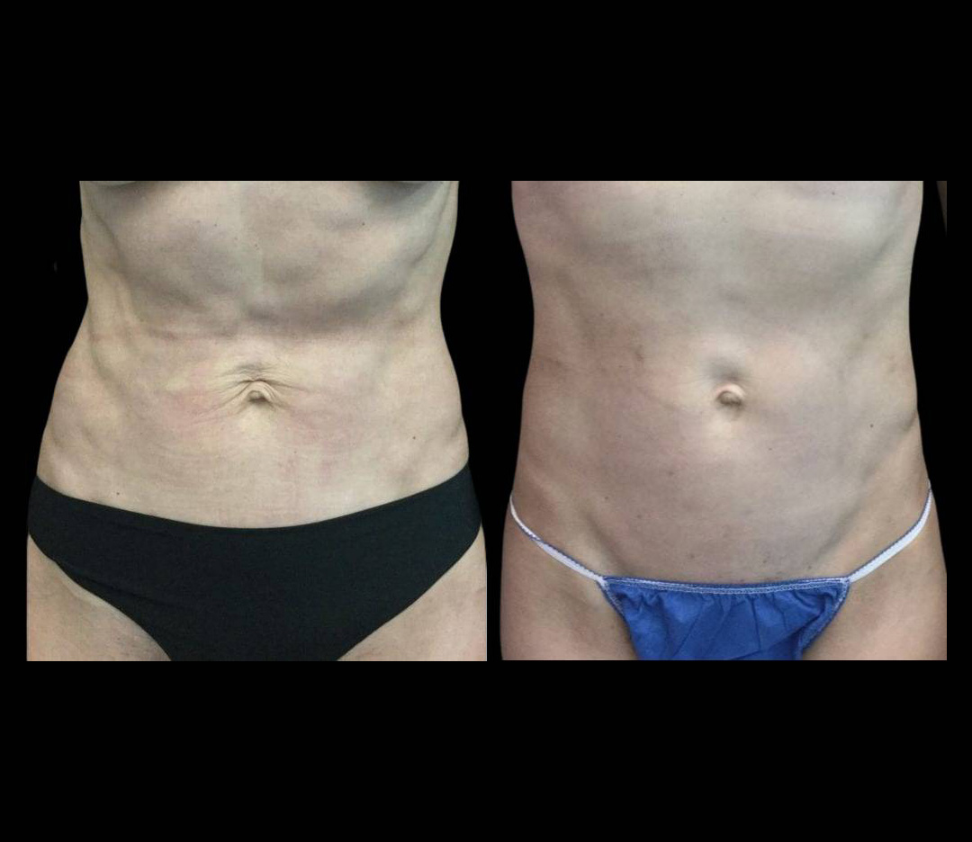 42-year-old-female-ultratherapy-before-and-after.jpg
