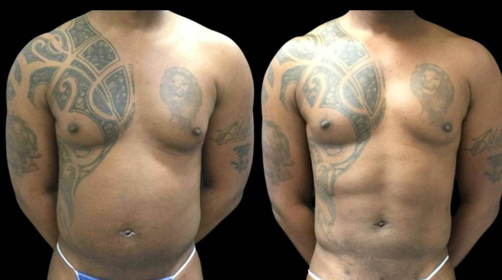This is a 42-year-old male that has had an abdominal etching done showing the before and after's side-by-side