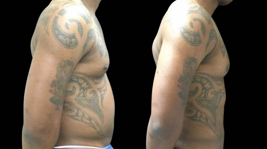 This is a 42-year-old male that has had an abdominal etching done showing the before and after's side-by-side