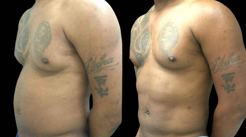 This is a 42-year-old male that has had an abdominal etching done showing the before and after's side-by-side