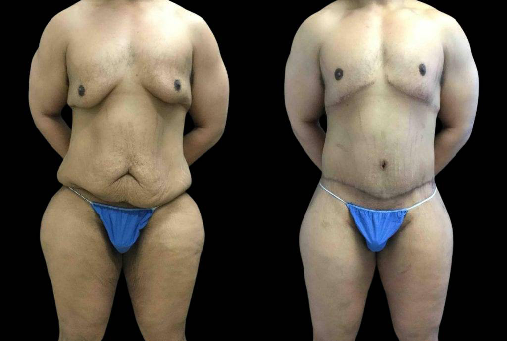 42-year-old-male-after-weight-loss-before-and-after-front-view-27216.jpg