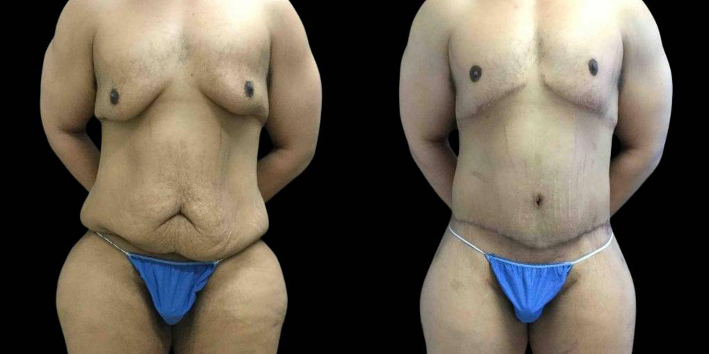 This is a 42-year-old male after weight loss showing the before and after's side-by-side