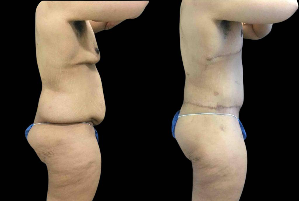 42-year-old-male-after-weight-loss-before-and-after-side-view.jpg