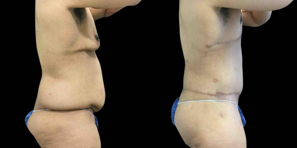 This is a 42-year-old male after weight loss showing the before and after's side-by-side