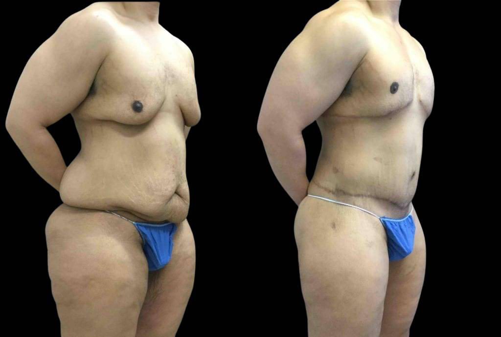 42-year-old-male-after-weight-loss-before-and-after-three-quarter-view.jpg