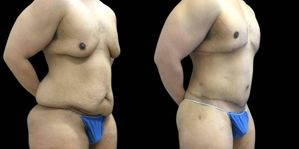 This is a 42-year-old male after weight loss showing the before and after's side-by-side