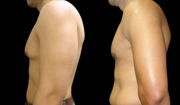 42-year-old-male-breast-reduction-before-and-after-side-view.jpg