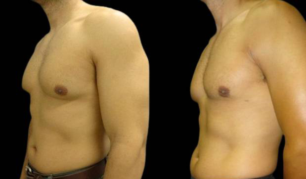 42-year-old-male-breast-reduction-before-and-after-three-quarters-view-16081.jpg