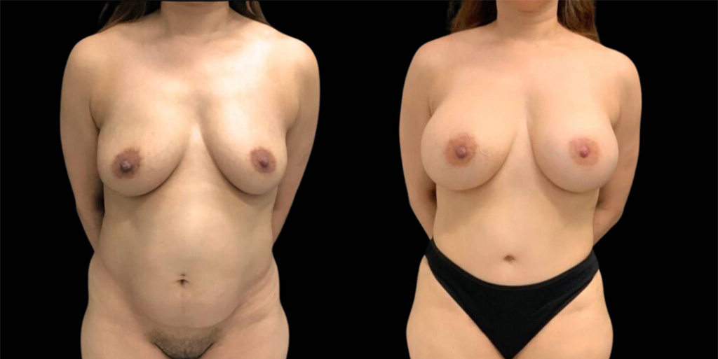 This is a 43-year-old female that has had a breast augmentation showing the before and after's side-by-side