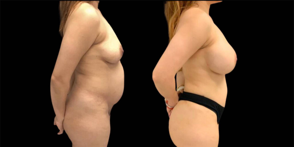This is a 43-year-old female that has had a breast augmentation showing the before and after's side-by-side