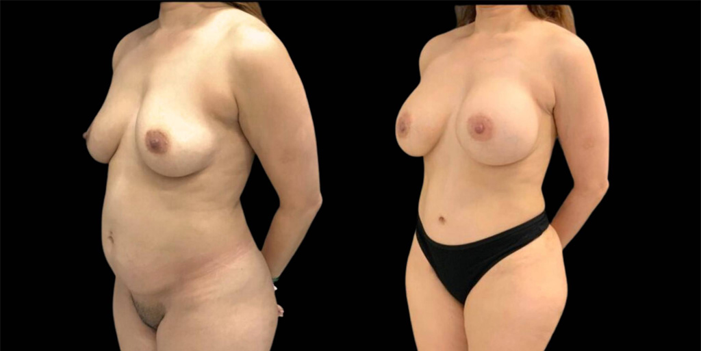 This is a 43-year-old female that has had a breast augmentation showing the before and after's side-by-side
