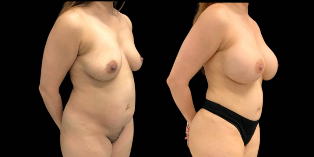 This is a 43-year-old female that has had a breast augmentation showing the before and after's side-by-side