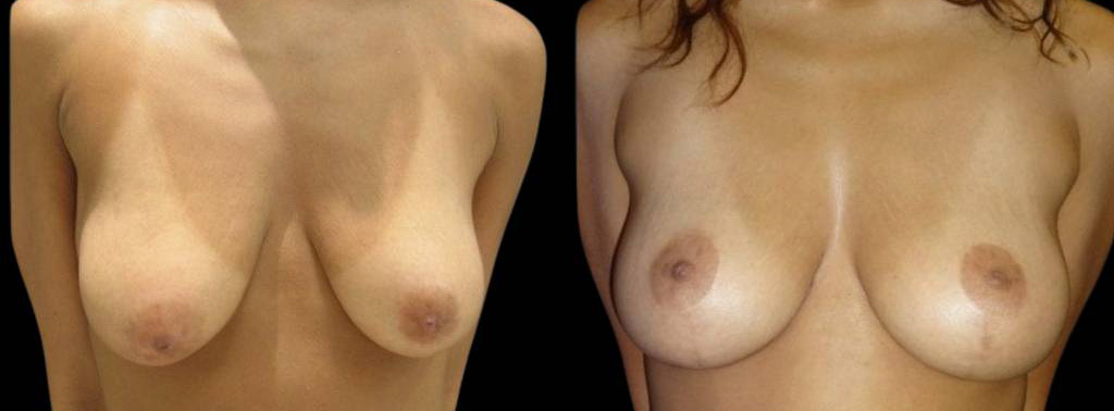 This is a 43-year-old female that has had an arm lift after weight loss showing the before and after's side-by-side