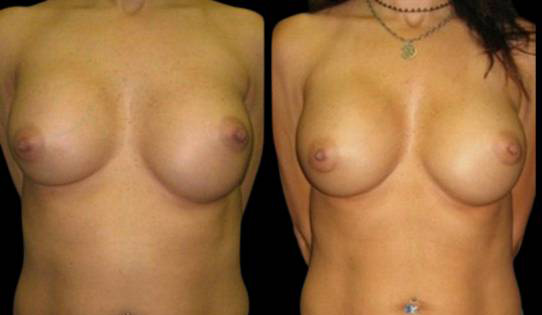 43-year-old-female-breast-implant-exchange-before-and-after-front-view.jpg