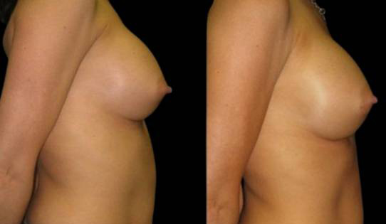 43-year-old-female-breast-implant-exchange-before-and-after-side-view-1.jpg