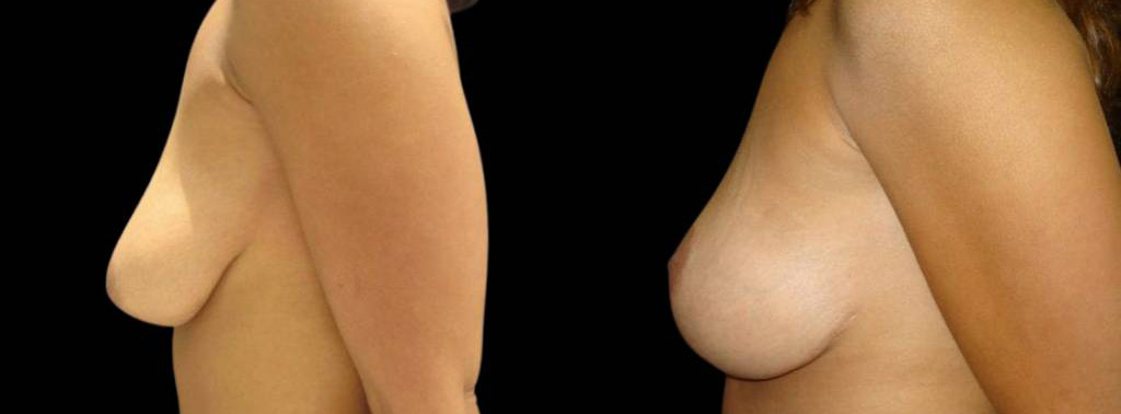 This is a 43-year-old female that has had an arm lift after weight loss showing the before and after's side-by-side