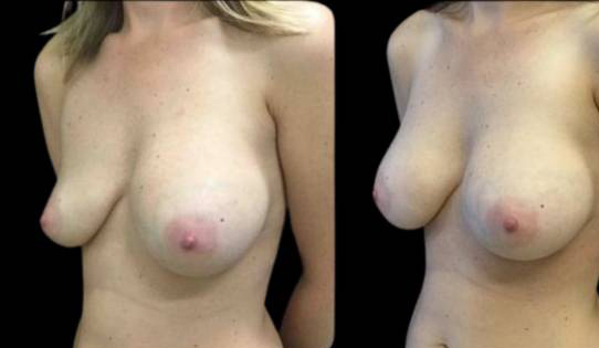 43-year-old-female-breast-implant-exchange-before-and-after-three-quarter-view-2.jpg