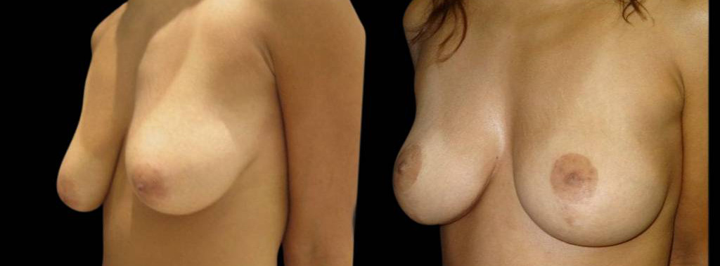 43-year-old-female-breast-lift-before-and-after-three-quarter-view.jpg