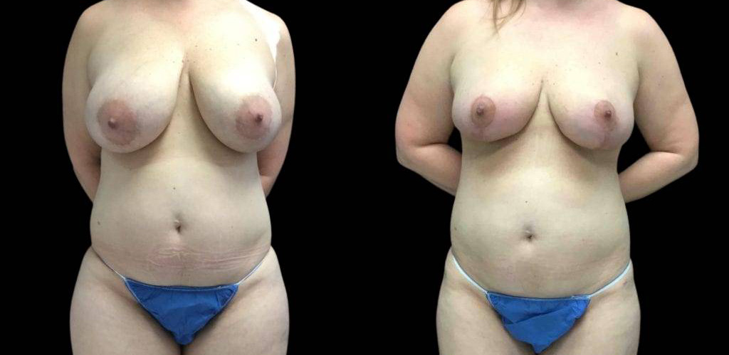 43-year-old-female-breast-reduction-before-and-after-front-view-26417.jpg
