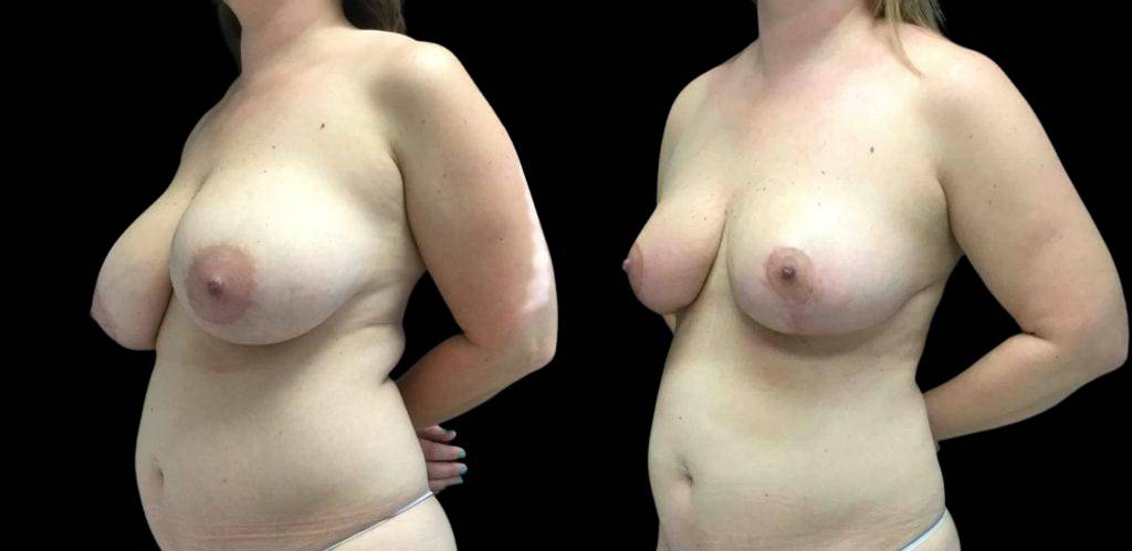43-year-old-female-breast-reduction-before-and-after-three-quarter-view.jpg
