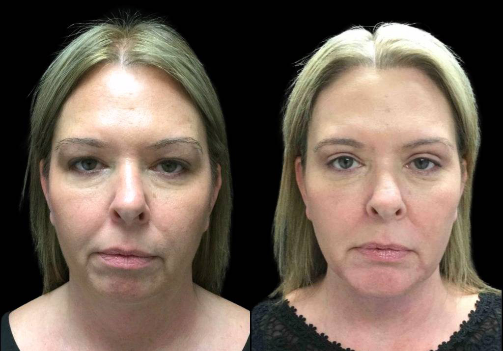 43-year-old-female-chin-implant-before-and-after-front-view-20922.jpg