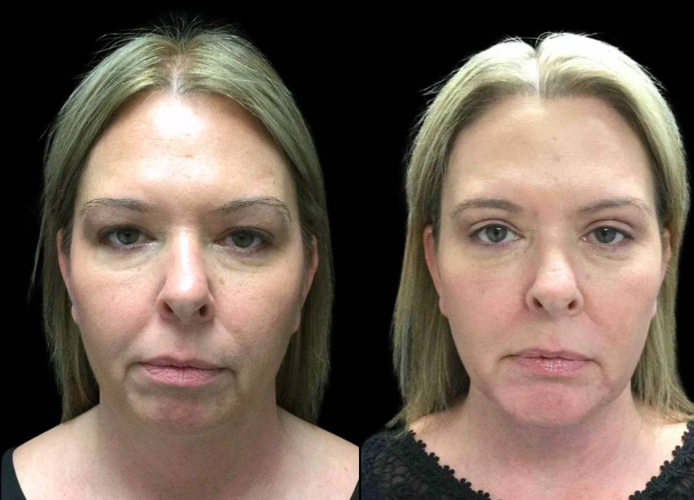 43-year-old-female-chin-implant-before-and-after-front-view-20922.jpg