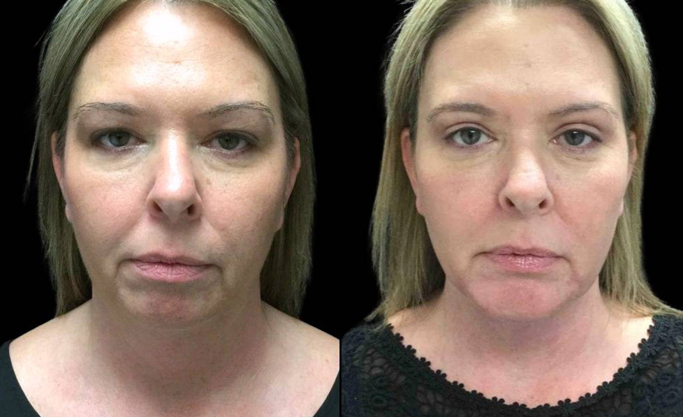 43-year-old-female-chin-implant-before-and-after-front-view-20922.jpg