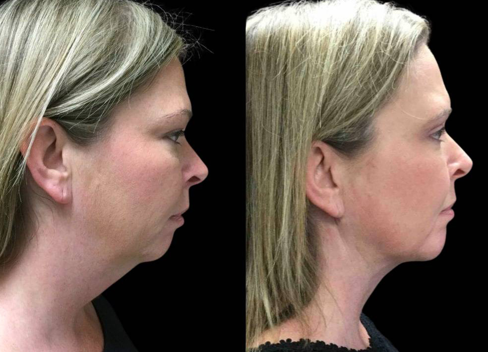 43-year-old-female-chin-implant-before-and-after-side-view.jpg